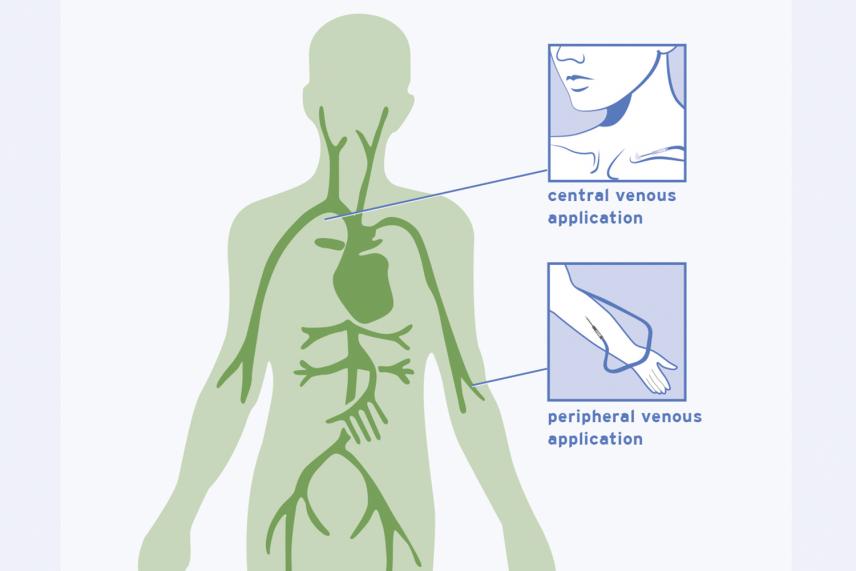 Fresenius Kabi | Central Versus Peripheral Administration