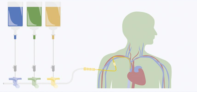 Sistema de frascos múltiplos.